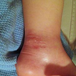 An Effective Natural Remedy for Severe Mosquito Bites