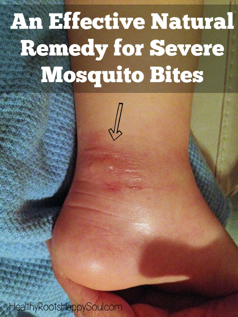 Finally!!! An Effective Natural Remedy for Severe Mosquito Bites. I couldn't believe how well this worked for my son!
