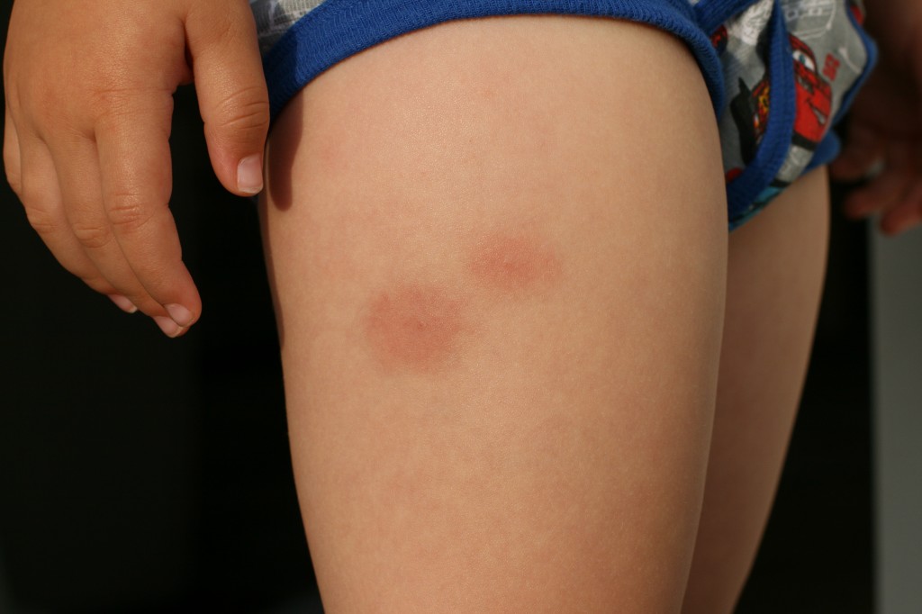 My son's severe reaction to bug bites (in particular mosquito). The only thing I've found to help (drastically) was the application of lavender EO