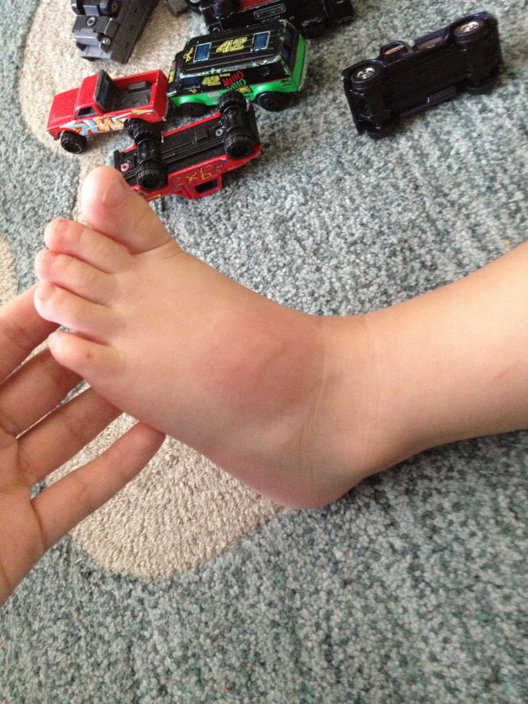My son's severe reaction to bug bites (in particular mosquito). The only thing I've found to help (drastically) was the application of lavender EO