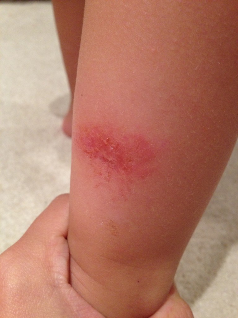 My son's severe reaction to bug bites (in particular mosquito). The only thing I've found to help (drastically) was the application of lavender EO